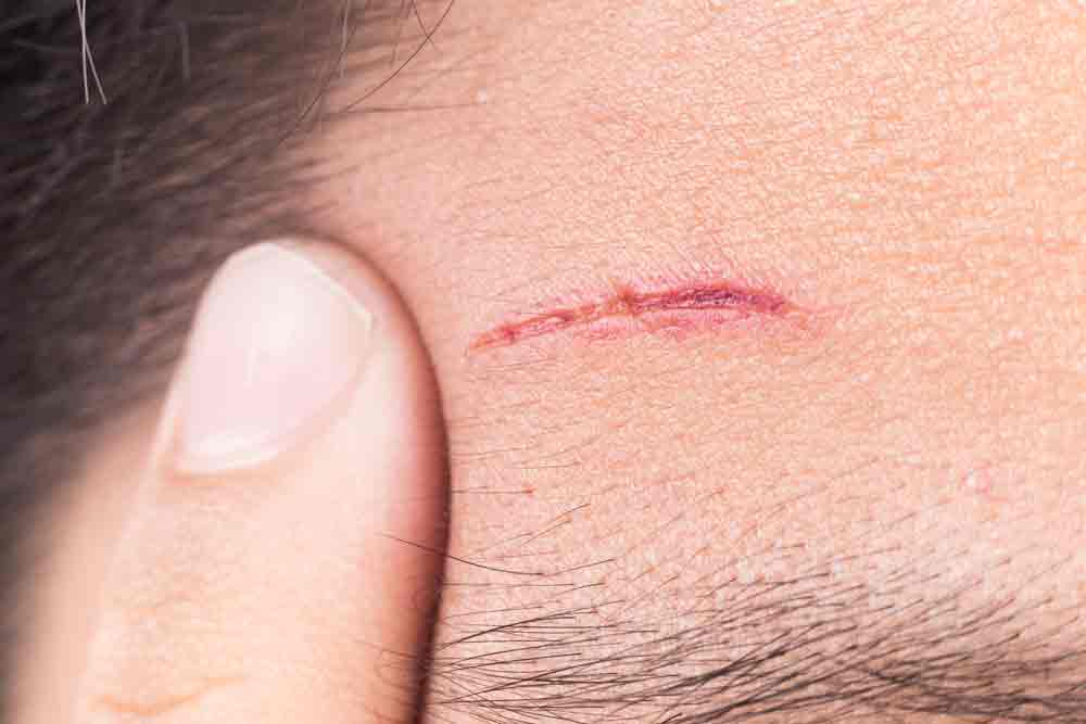 Scar Removal And Revision