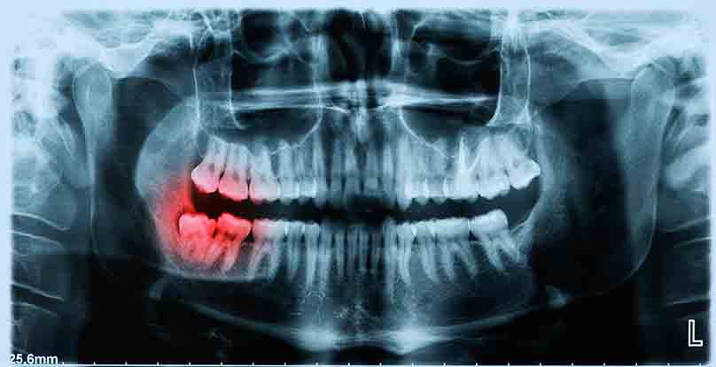 impacted_tooth x-ray