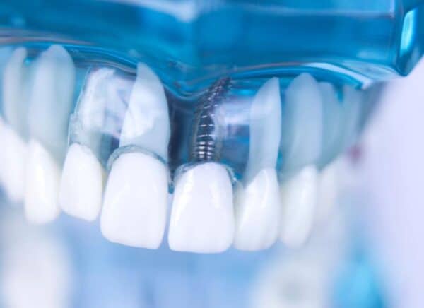 Dental Implants Near Knoxville And Maryville Tennessee Valley Oral