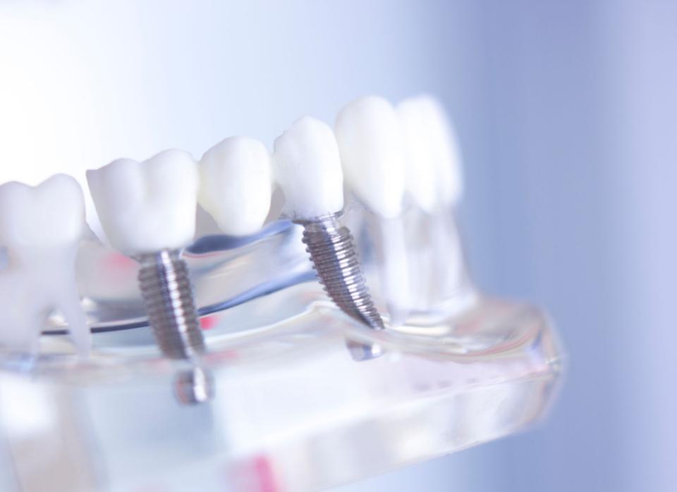 best dental implants 1