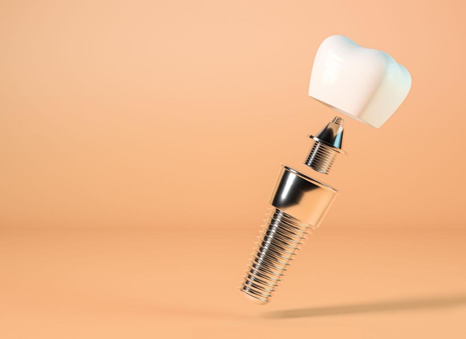 how long do dental implants last 1