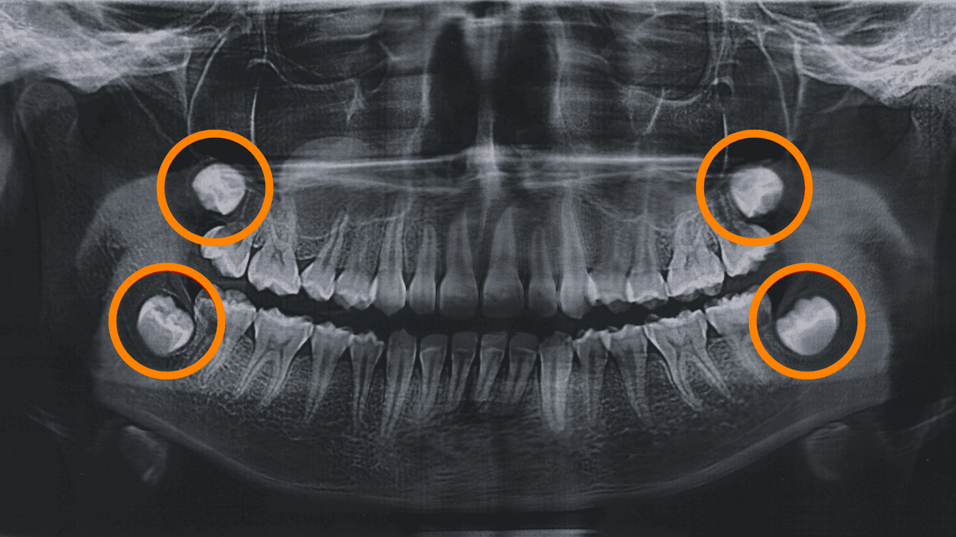 wisdom teeth