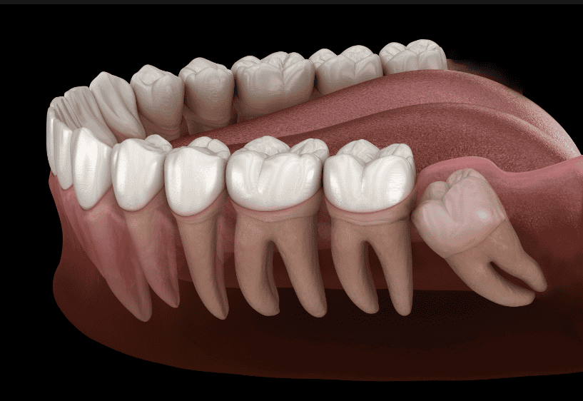 impacted teeth