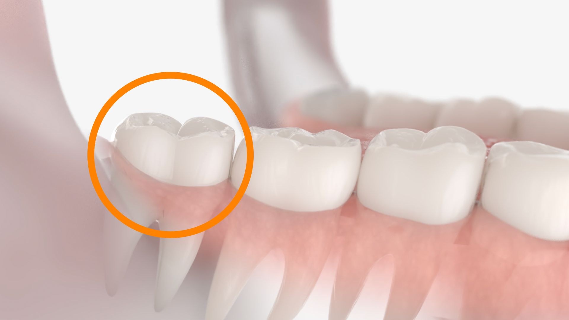 wisdom tooth illustration