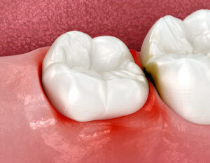 impaction of wisdom teeth, gum inflammation. 3d illustration