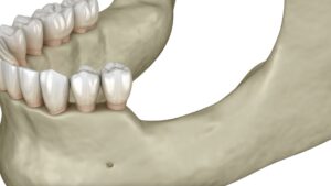 bone loss
