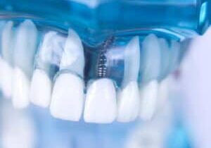 best dental implants 2